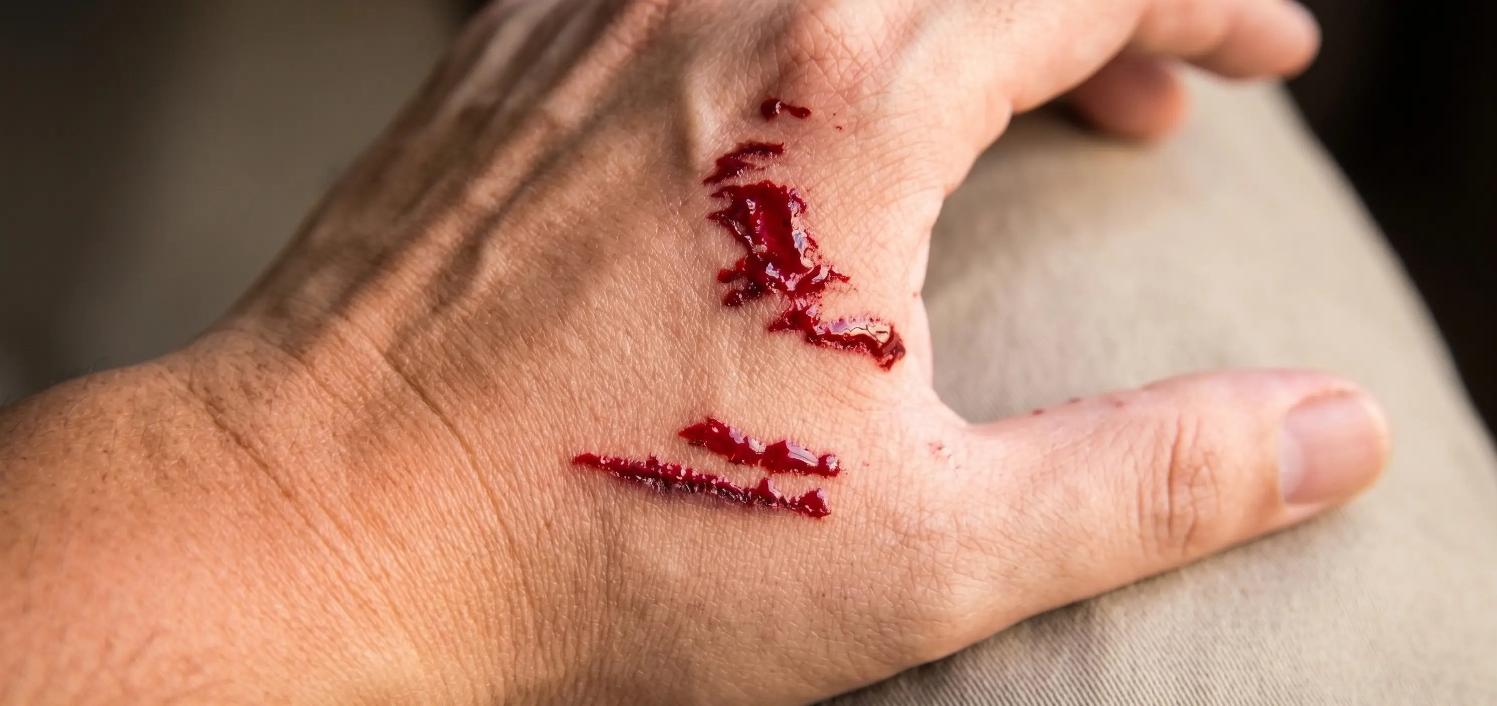 Close-up of a hand with bite wounds after an animal attack